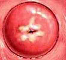 Displazie de col uterin