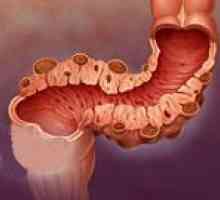 Diverticulii de colon sigmoid