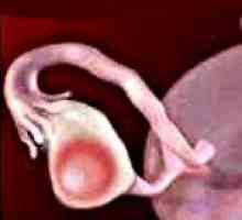 Tumorile benigne ale ovarelor