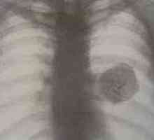 Tumori pulmonare benigne