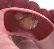 Tumorile benigne ale intestinului subțire