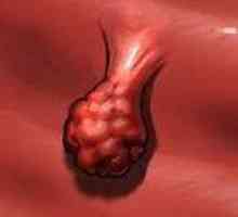 Tumorile benigne ale vaginului
