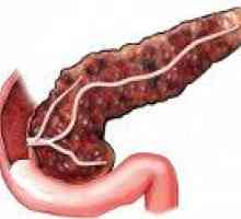 Fibroza pancreasului