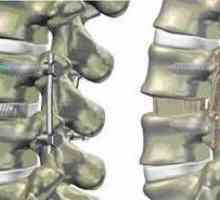Fixare a coloanei vertebrale în spondilolistezis, reducerea înălțimii discului intervertebral