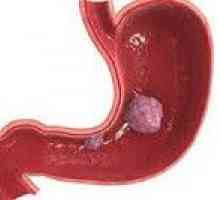 Tumorile stromale gastro-intestinale
