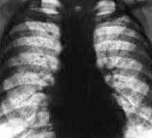 Hemosideroza pulmonară