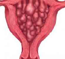 Hiperplazie endometrială
