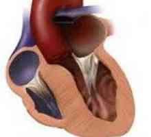 Cardiomiopatie hipertrofică
