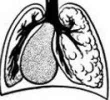 Hipoplazie a plămânilor