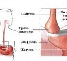 Hernie esofagian
