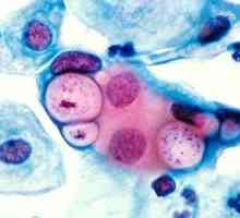 Chlamydia: simptome si tratament
