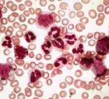 Leucemia mieloidă cronică