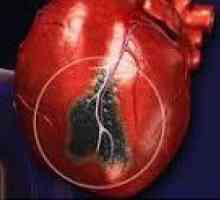 Infarct miocardic
