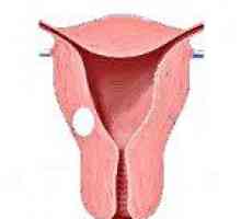 Fibrom uterin interstițiale