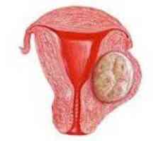 Fibrom uterin interstițiale