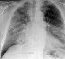 Pneumonie interstițială