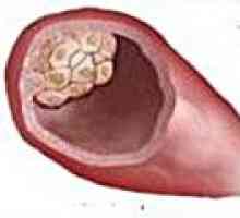 Carcinomul ductal invaziv al sânului