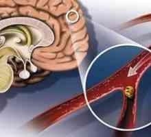 Accident vascular cerebral ischemic cerebral