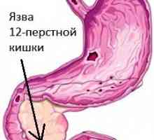 Ulcer duodenal: simptome, tratament