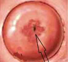 Ectopic de col uterin