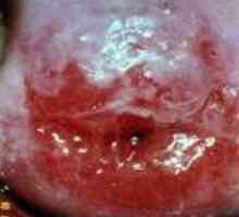 Ectropion de col uterin