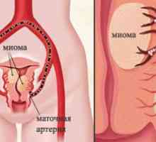Embolizarea arterelor uterine (EMA), miomul uterin