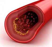 Cum de a reduce colesterolul din sânge?