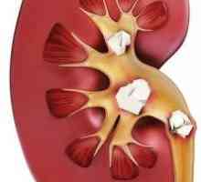 Pietrele la rinichi: simptome, tratament