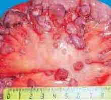 Carcinomatoza peritoneala