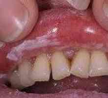 Candidoza orală