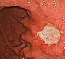 Tumorile carcinoide ale tractului gastro-intestinal