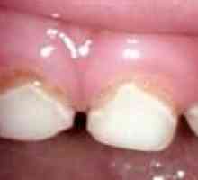 Tratamentul de dinți primari