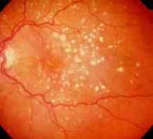 Carotenoidele în tratamentul legate de varsta degenerescenta maculara a retinei