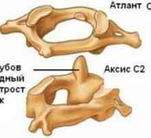 Tratamentul fracturilor de vertebre c1