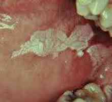 Leucoplazie orală