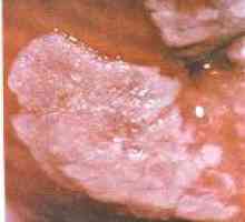 Leucoplazie de col uterin