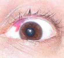 Deteriorările mecanice pentru ochi