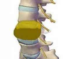 Metastazele la nivelul coloanei vertebrale