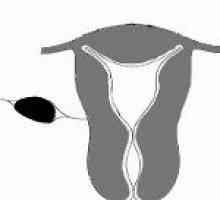 Fibrom uterin Mezhsvyazochnaya