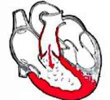 Insuficiența valvei pulmonare