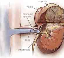 Nefroblastomul rinichi (tumora Wilms) la copii