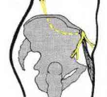 Neuropatia extern nervului cutanat femural