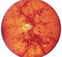 Ocluzia venei centrale a retinei