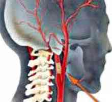 Ocluzia arterelor carotide