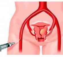 Chirurgie pentru a elimina fibrom uterin