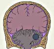 Tumorile cerebelului