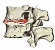 Osteocondrozei