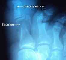 Osteomielită