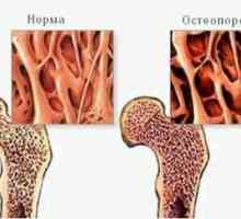 Osteoporoza osoase