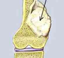 Osteosarcom